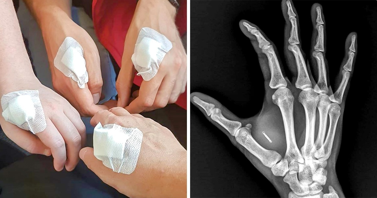 Oamenii din Suedia își perfecționează mâinile si isi implanteaza cipuri, lucru care sperie destul de multa lume