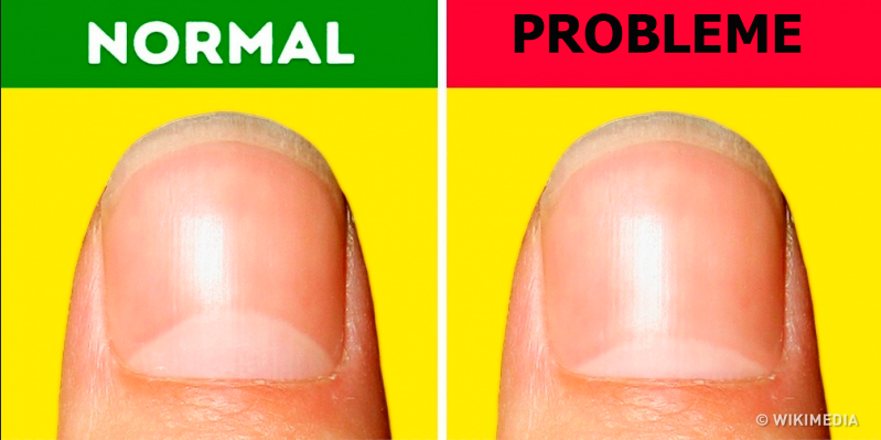 13 Probleme de sănătate pe care le poti observa uitandu-te la unghiile tale
