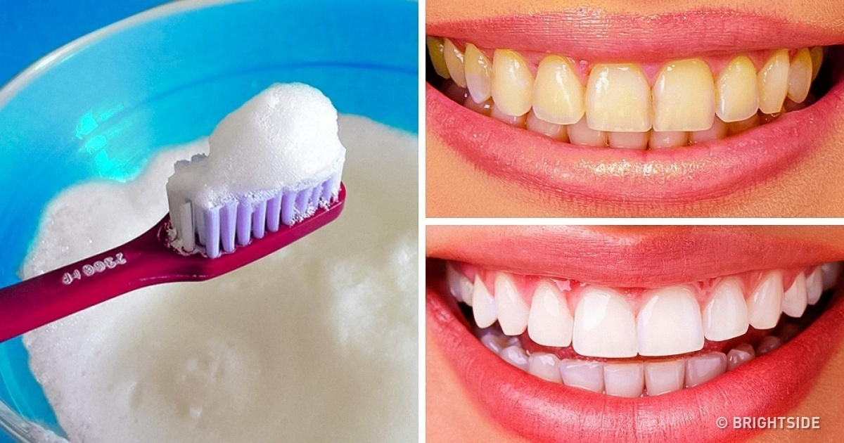 10 modalități simple de albire a dintilor la tine acasa