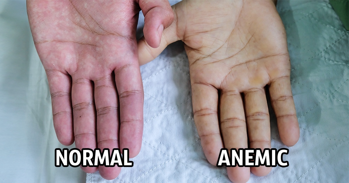 Acestea sunt cele mai mari semne ale anemiei pe care nu le cunoașteți !!